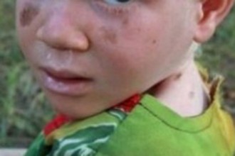 Côte d'Ivoire : Un enfant albinos échappe à  un crime rituel